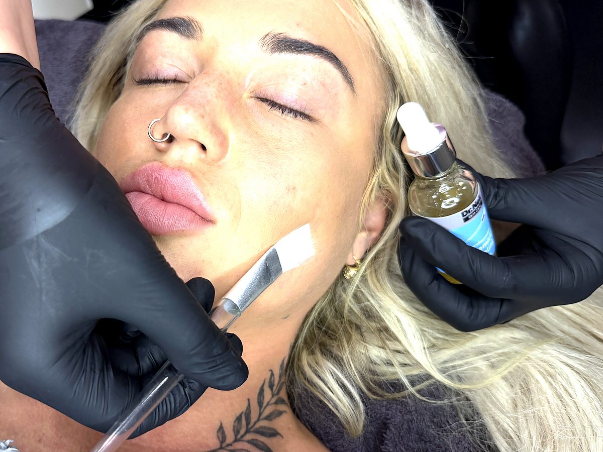 Chemical peel course