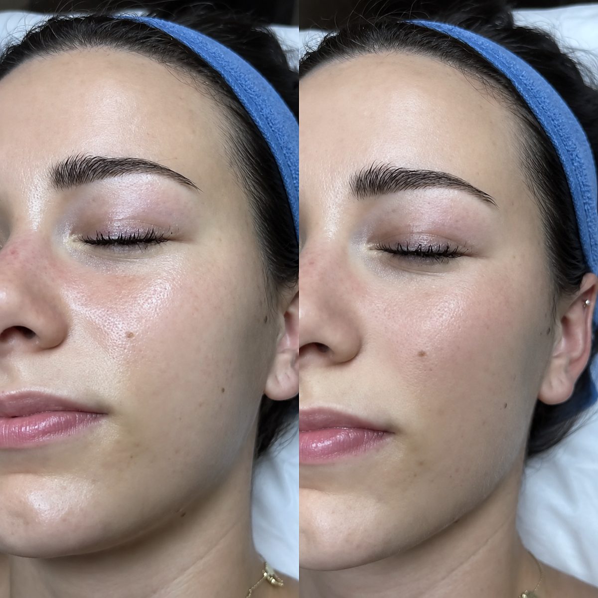 Online kurz dermaplaningu